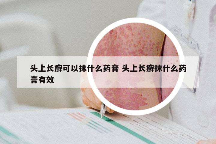 头上长癣可以抹什么药膏 头上长癣抹什么药膏有效