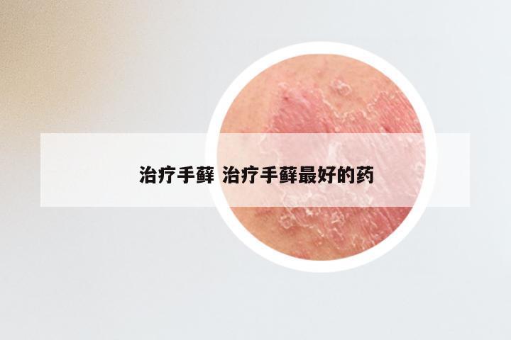 治疗手藓 治疗手藓最好的药