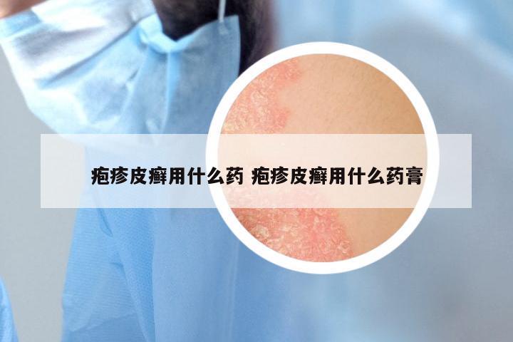 疱疹皮癣用什么药 疱疹皮癣用什么药膏