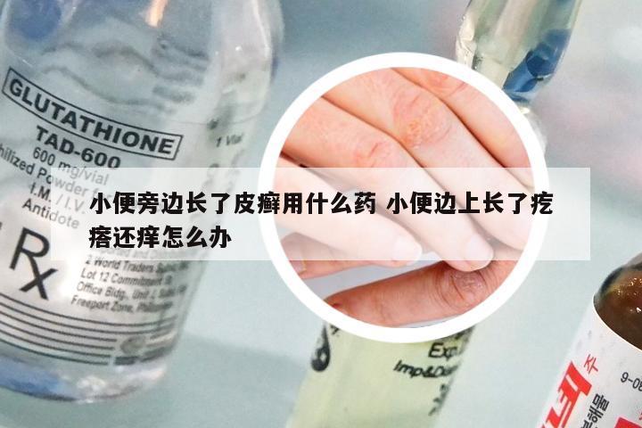 小便旁边长了皮癣用什么药 小便边上长了疙瘩还痒怎么办