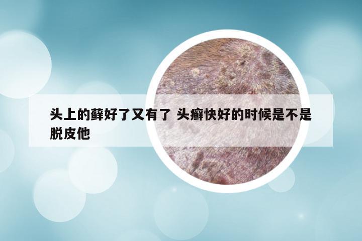头上的藓好了又有了 头癣快好的时候是不是脱皮他