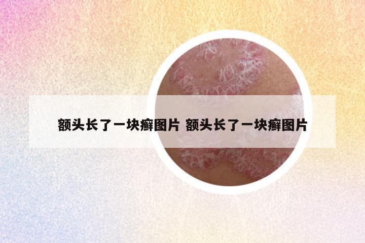 额头长了一块癣图片 额头长了一块癣图片