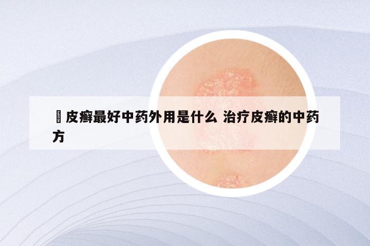 牜皮癣最好中药外用是什么 治疗皮癣的中药方