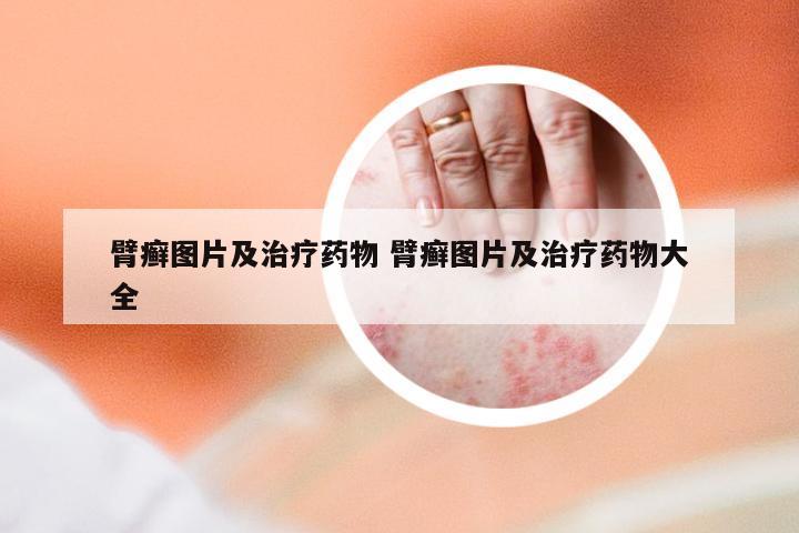 臂癣图片及治疗药物 臂癣图片及治疗药物大全