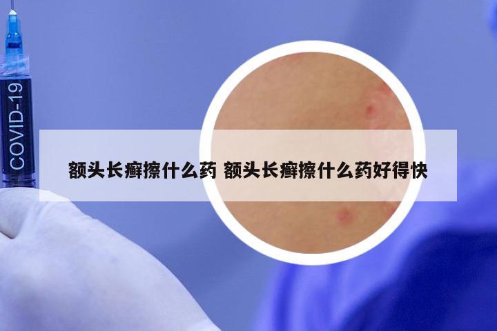 额头长癣擦什么药 额头长癣擦什么药好得快