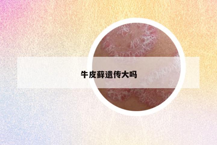牛皮藓遗传大吗