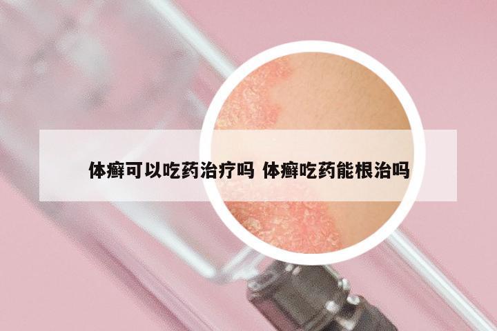 体癣可以吃药治疗吗 体癣吃药能根治吗