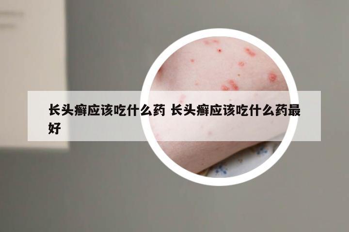 长头癣应该吃什么药 长头癣应该吃什么药最好