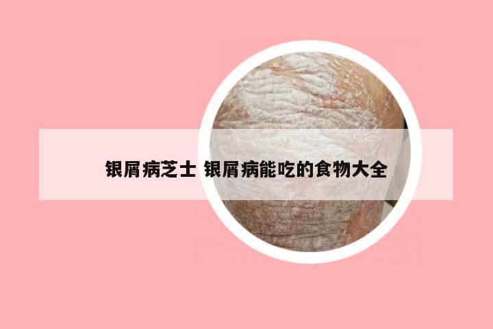 银屑病芝士 银屑病能吃的食物大全