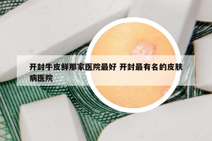 开封牛皮鲜那家医院最好 开封最有名的皮肤病医院