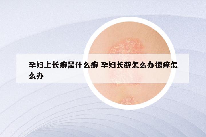 孕妇上长癣是什么癣 孕妇长藓怎么办很痒怎么办