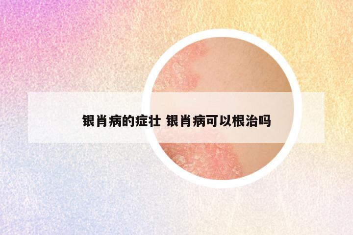 银肖病的症壮 银肖病可以根治吗