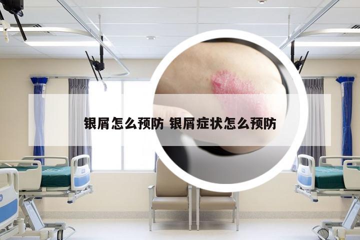 银屑怎么预防 银屑症状怎么预防