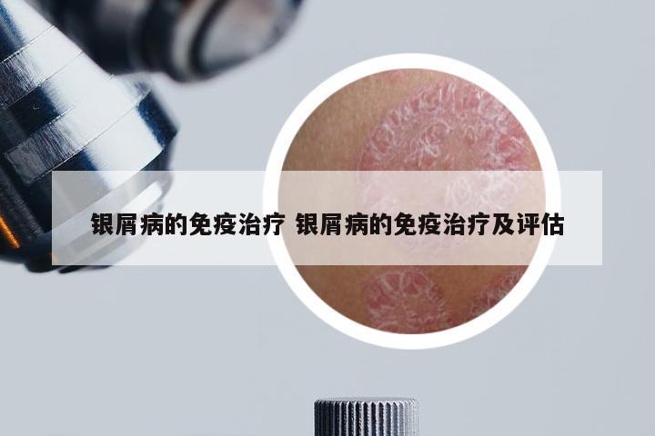 银屑病的免疫治疗 银屑病的免疫治疗及评估
