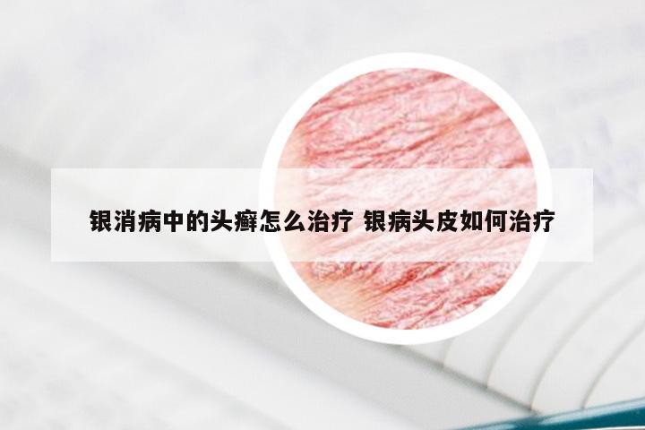 银消病中的头癣怎么治疗 银病头皮如何治疗