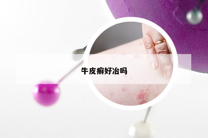 牛皮癣好冶吗