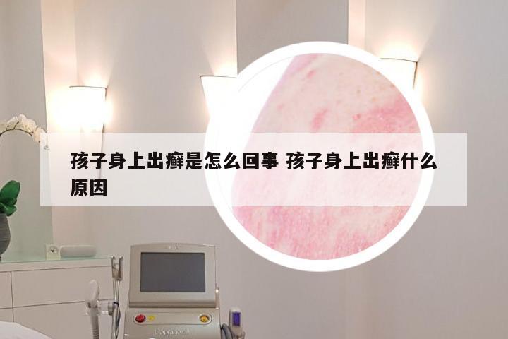 孩子身上出癣是怎么回事 孩子身上出癣什么原因