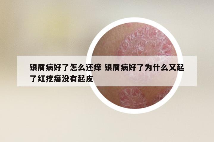 银屑病好了怎么还痒 银屑病好了为什么又起了红疙瘩没有起皮