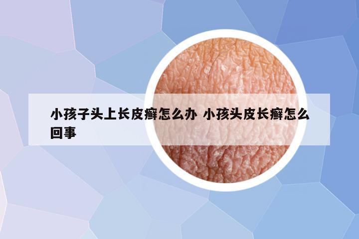 小孩子头上长皮癣怎么办 小孩头皮长癣怎么回事