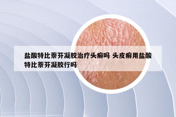 盐酸特比萘芬凝胶治疗头癣吗 头皮癣用盐酸特比萘芬凝胶行吗