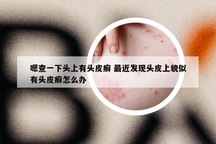 嗯查一下头上有头皮癣 最近发现头皮上貌似有头皮癣怎么办