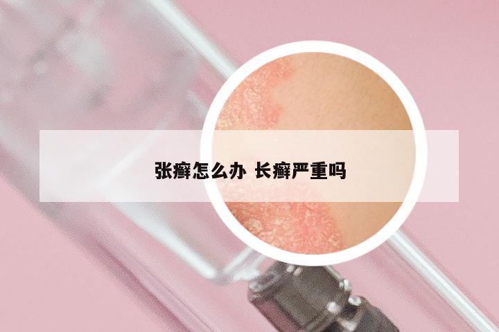 张癣怎么办 长癣严重吗
