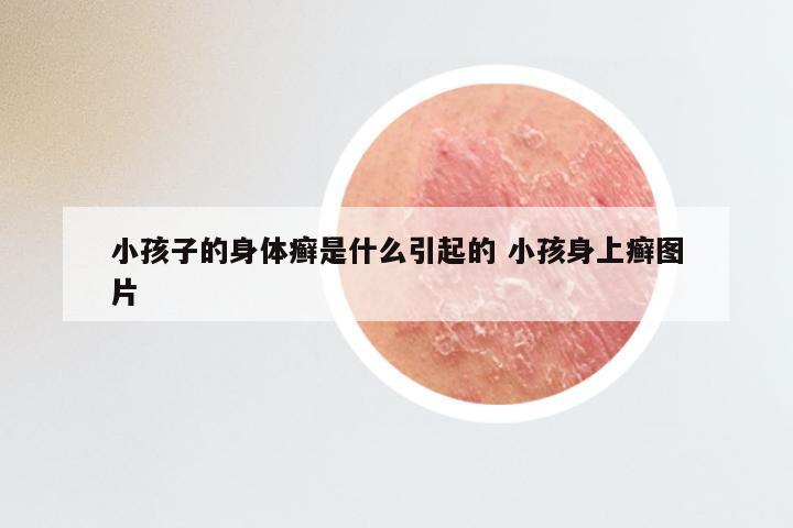 小孩子的身体癣是什么引起的 小孩身上癣图片