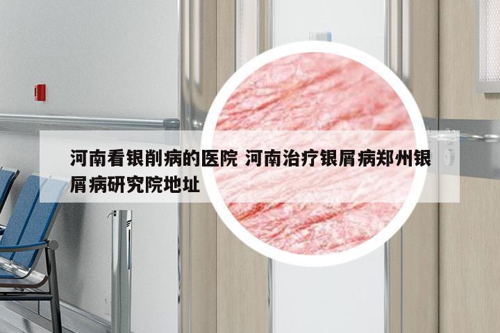 河南看银削病的医院 河南治疗银屑病郑州银屑病研究院地址