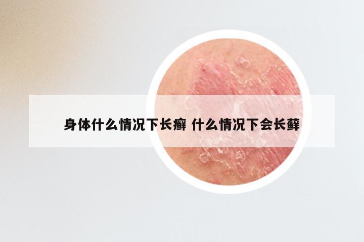 身体什么情况下长癣 什么情况下会长藓