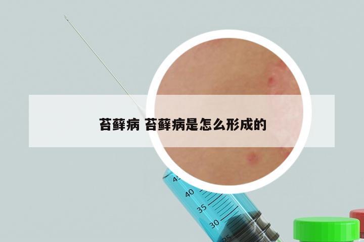 苔藓病 苔藓病是怎么形成的