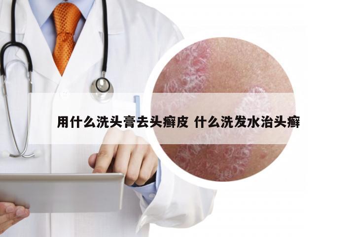 用什么洗头膏去头癣皮 什么洗发水治头癣