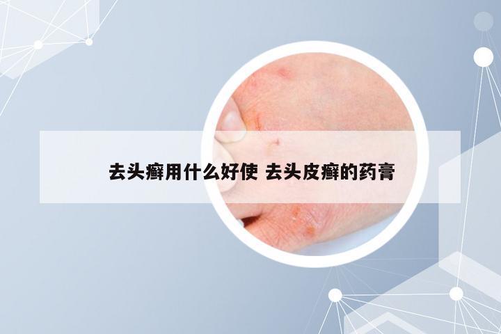 去头癣用什么好使 去头皮癣的药膏