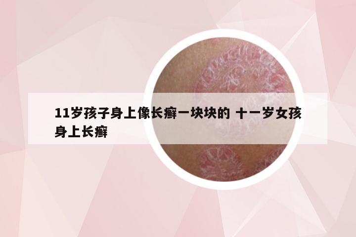 11岁孩子身上像长癣一块块的 十一岁女孩身上长癣