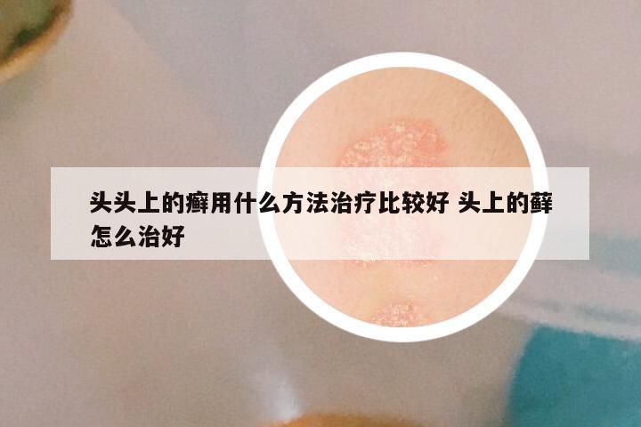 头头上的癣用什么方法治疗比较好 头上的藓怎么治好