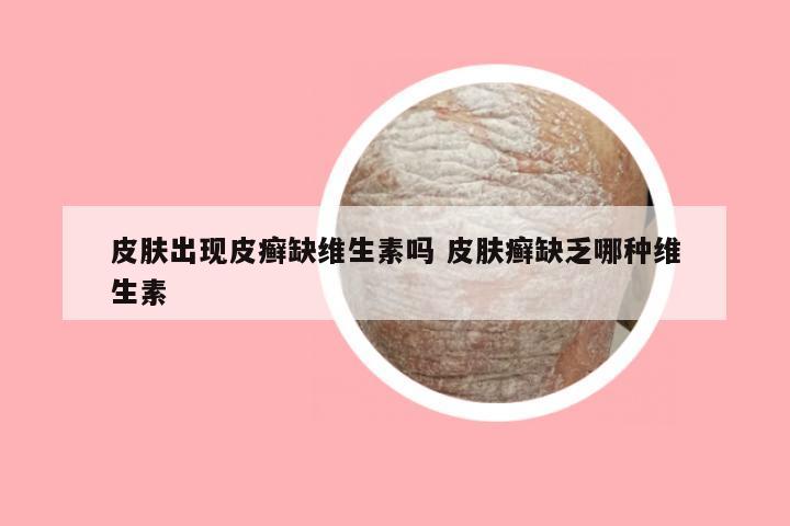 皮肤出现皮癣缺维生素吗 皮肤癣缺乏哪种维生素