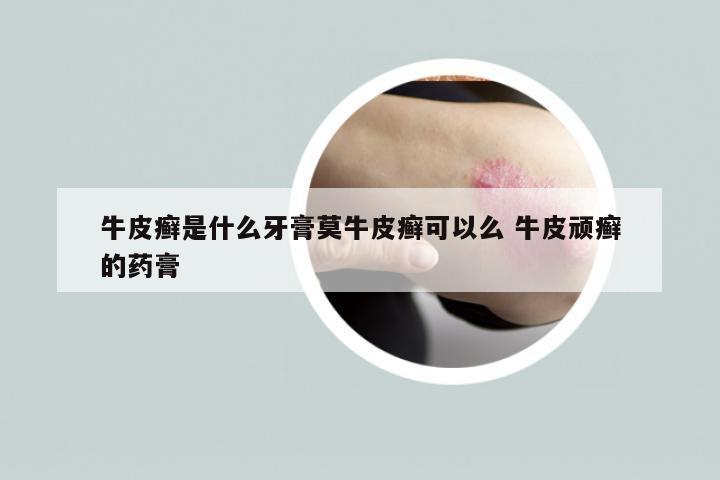 牛皮癣是什么牙膏莫牛皮癣可以么 牛皮顽癣的药膏
