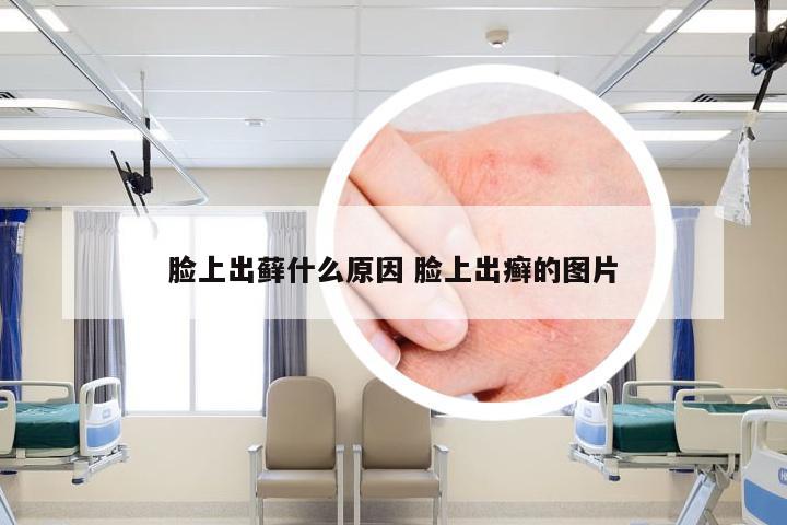 脸上出藓什么原因 脸上出癣的图片