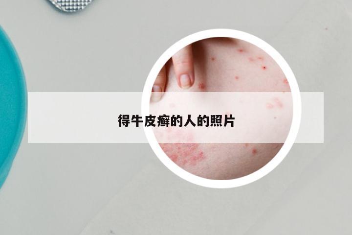 得牛皮癣的人的照片