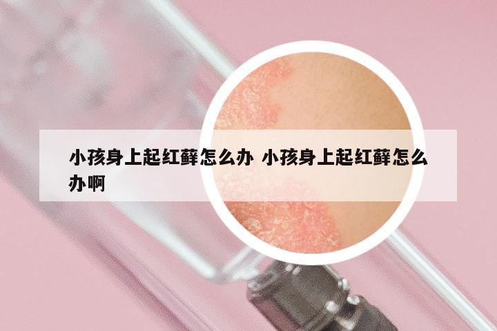 小孩身上起红藓怎么办 小孩身上起红藓怎么办啊