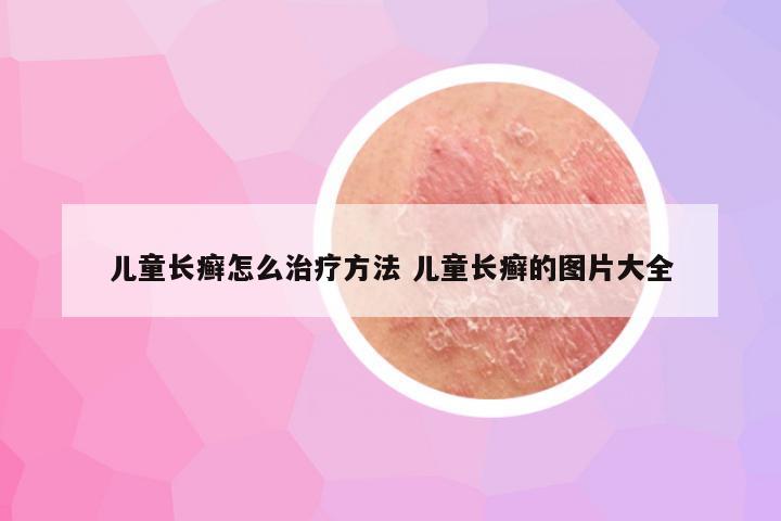 儿童长癣怎么治疗方法 儿童长癣的图片大全