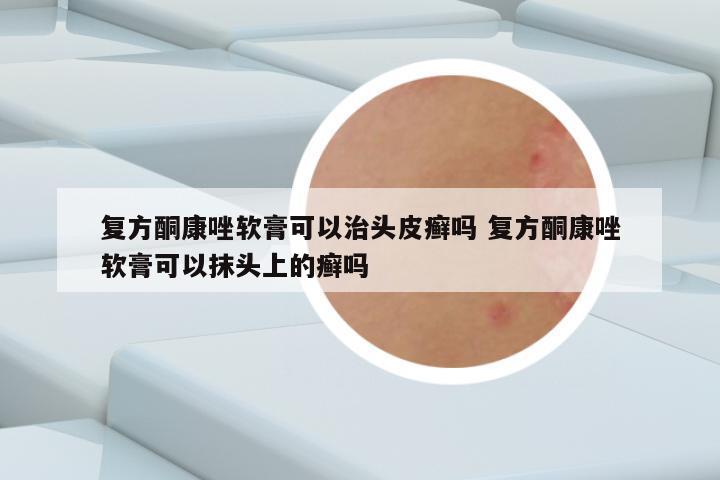 复方酮康唑软膏可以治头皮癣吗 复方酮康唑软膏可以抹头上的癣吗
