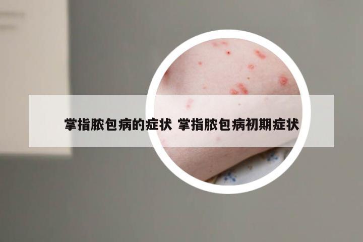 掌指脓包病的症状 掌指脓包病初期症状