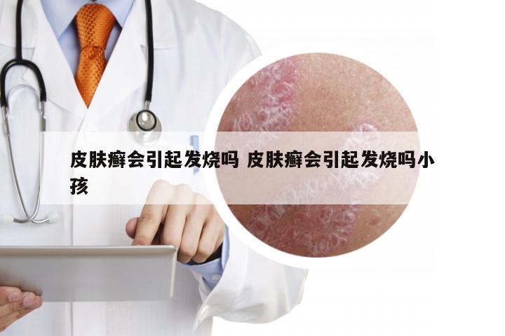 皮肤癣会引起发烧吗 皮肤癣会引起发烧吗小孩