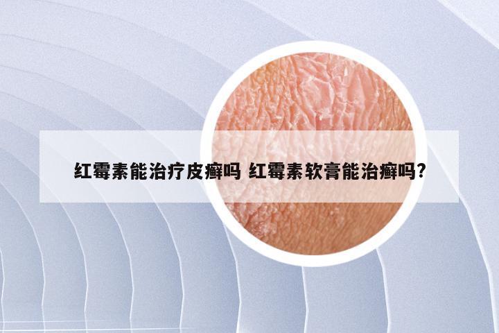 红霉素能治疗皮癣吗 红霉素软膏能治癣吗?