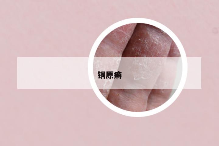 铜原癣