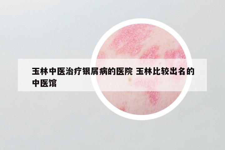 玉林中医治疗银屑病的医院 玉林比较出名的中医馆
