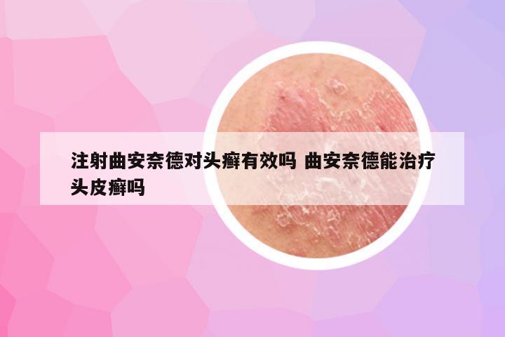注射曲安奈德对头癣有效吗 曲安奈德能治疗头皮癣吗