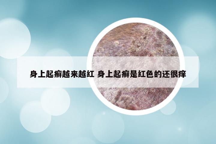身上起癣越来越红 身上起癣是红色的还很痒