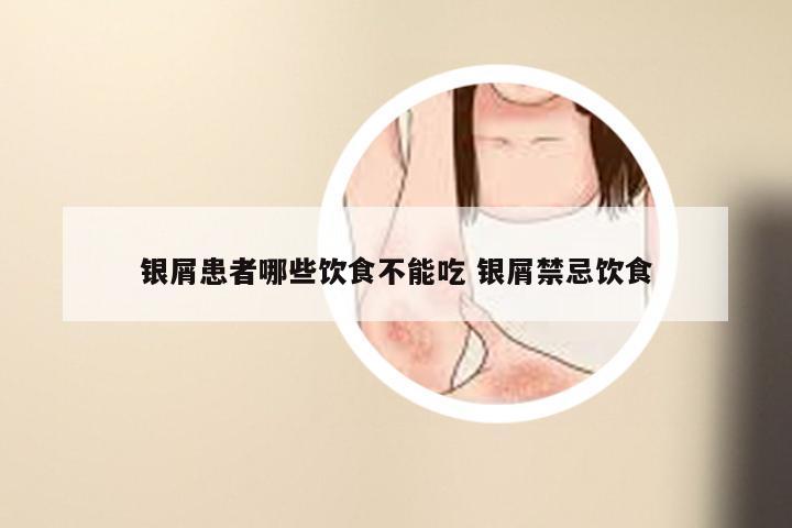 银屑患者哪些饮食不能吃 银屑禁忌饮食