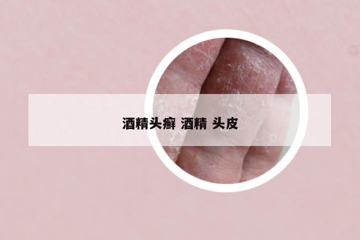 酒精头癣 酒精 头皮